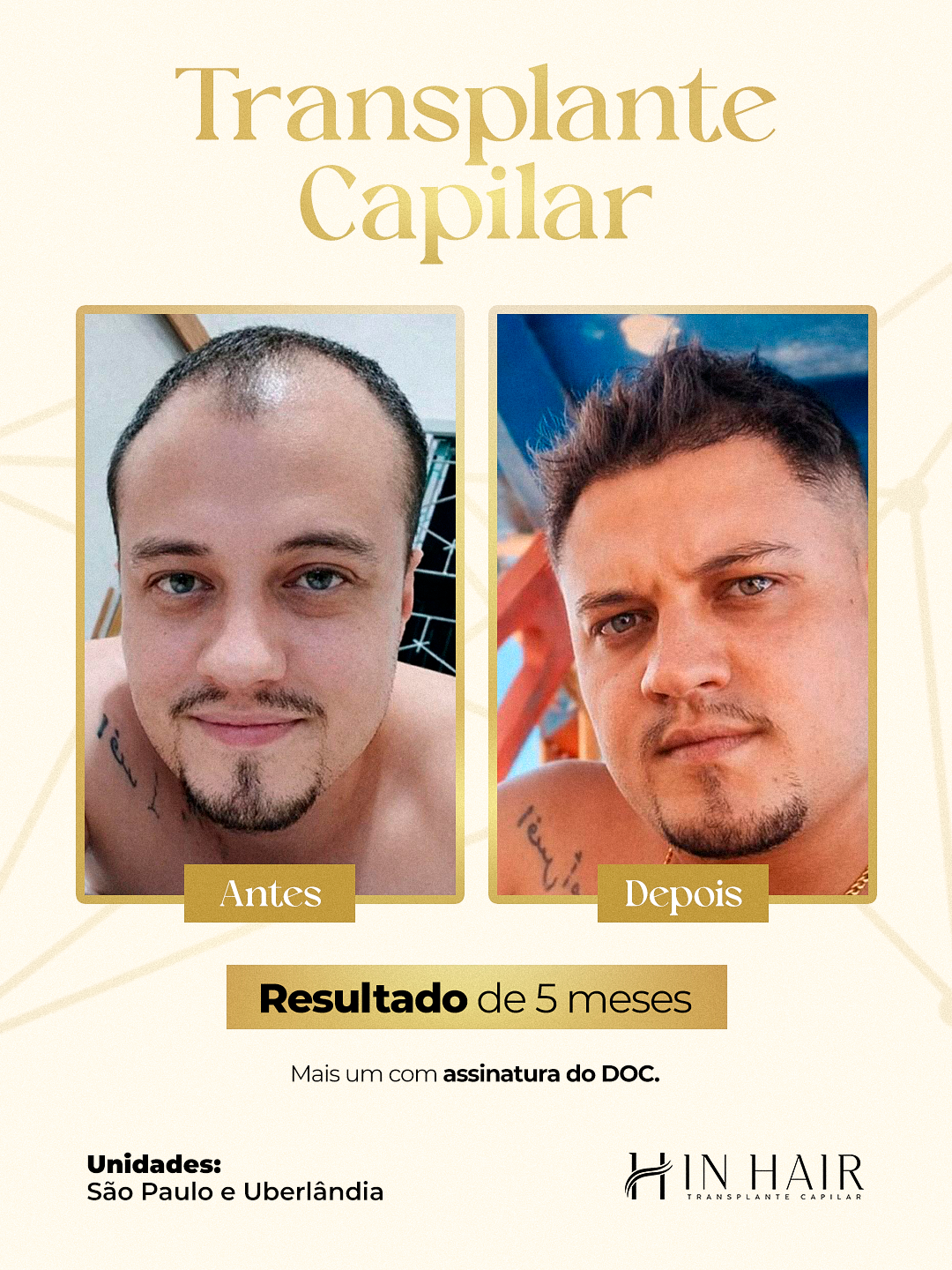 Arte-estática-RESULTADOS-TRANSPLANTES-CAPILAR---In-Hair-FEED
